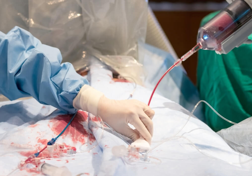 Coronary Angioplasty Process