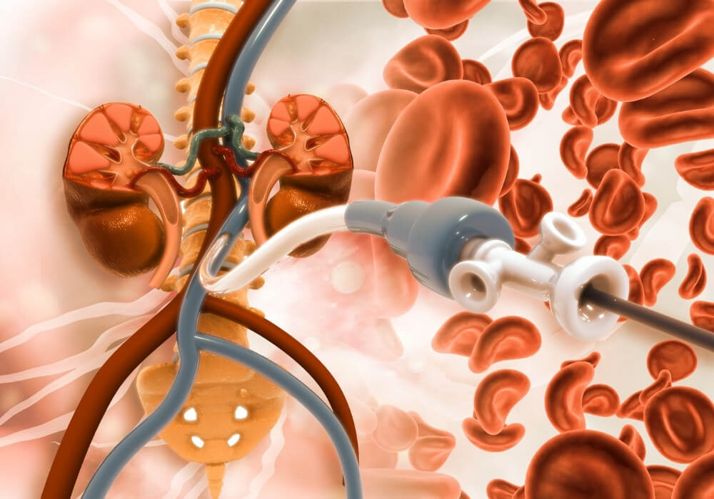 Peripheral Angiogram Procedures