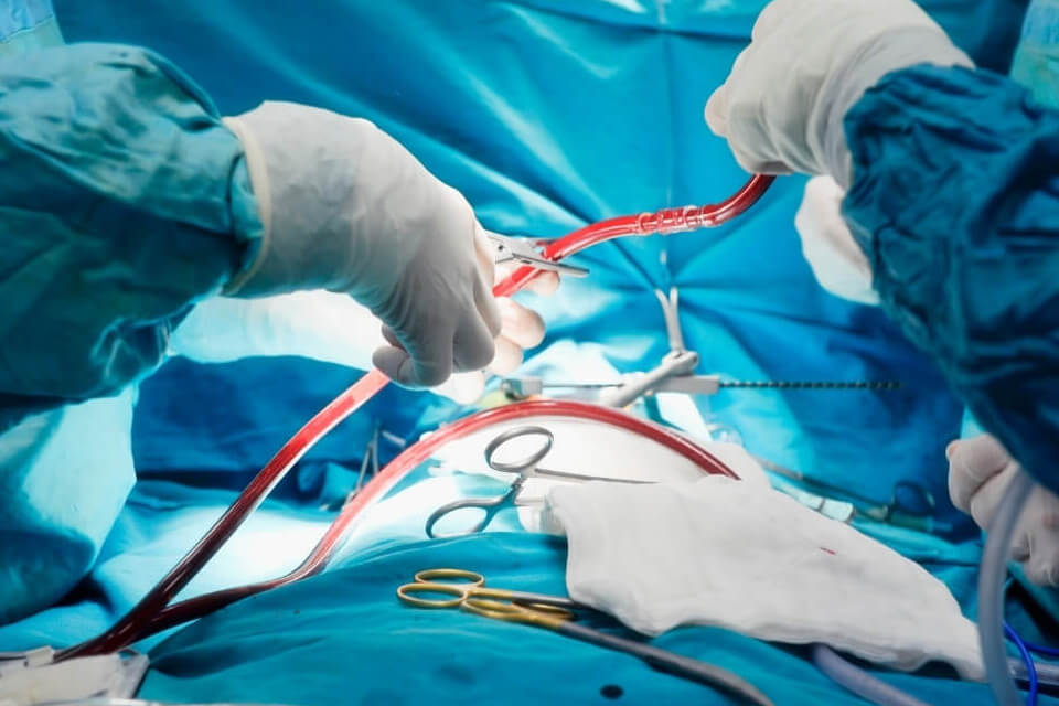 Open Heart Surgery Process