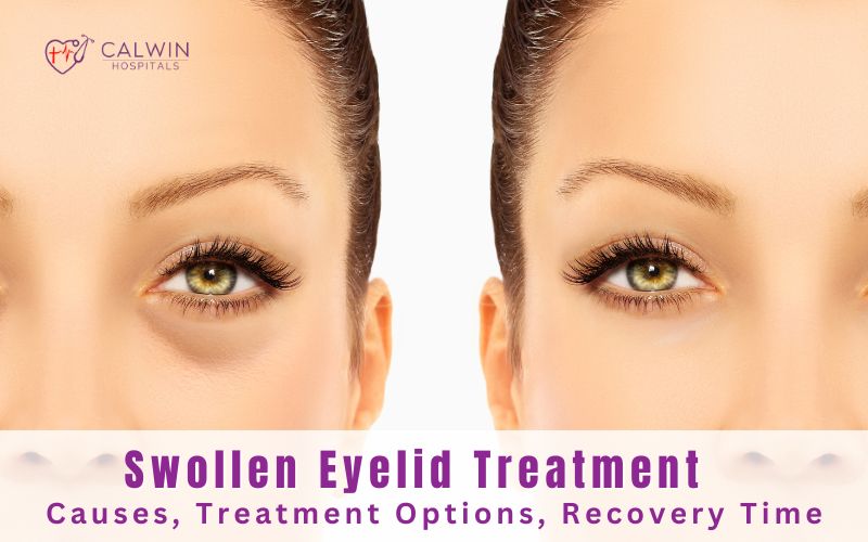 Swollen Eyelid Treatment