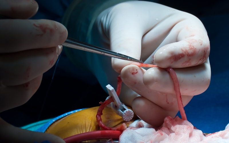 coronary artery bypass surgeon